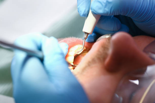 Best Emergency Dentist for Lost Fillings or Crowns in Riverton, IL